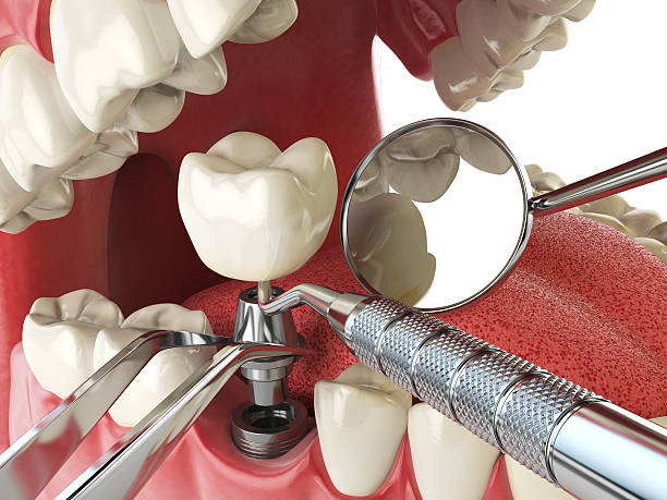 Best Emergency Tooth Extraction in Palmetto, FL